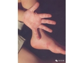 东莞手足口病爆发,不排除现死亡病例,该如何预防? 东莞手足口病爆发,不排除现死亡病例,该如何预防?