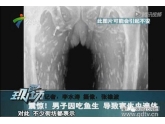 吓尿了!一广东男子因爱吃鱼生,致全身长满寄生虫! 吓尿了!一广东男子因爱吃鱼生,致全身长满寄生虫!